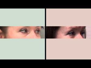 Нижняя трансконьюнктивальная блефаропластика. Хирург Соколов А.А.