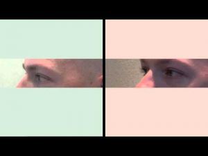 Блефаропластика нижних век. Хирург Соколов А.А.