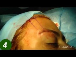 Нитевой лифтинг бровей. Хирург Алиев Э.С.