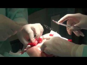 Установка золотых нитей. Хирург Соколов А.А. Часть 2