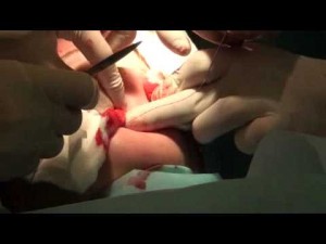 Установка золотых нитей. Хирург Соколов А.А. Часть 1