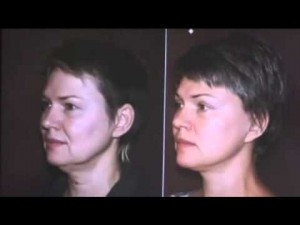 Салиджанов А. Ш. рассказывает о пластике лица.