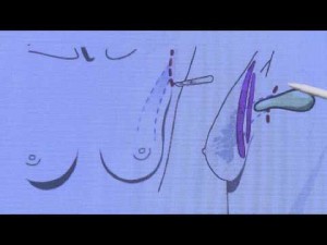 Александр Соколов рассказывает о выборе места доступа при установке имплантатов. 